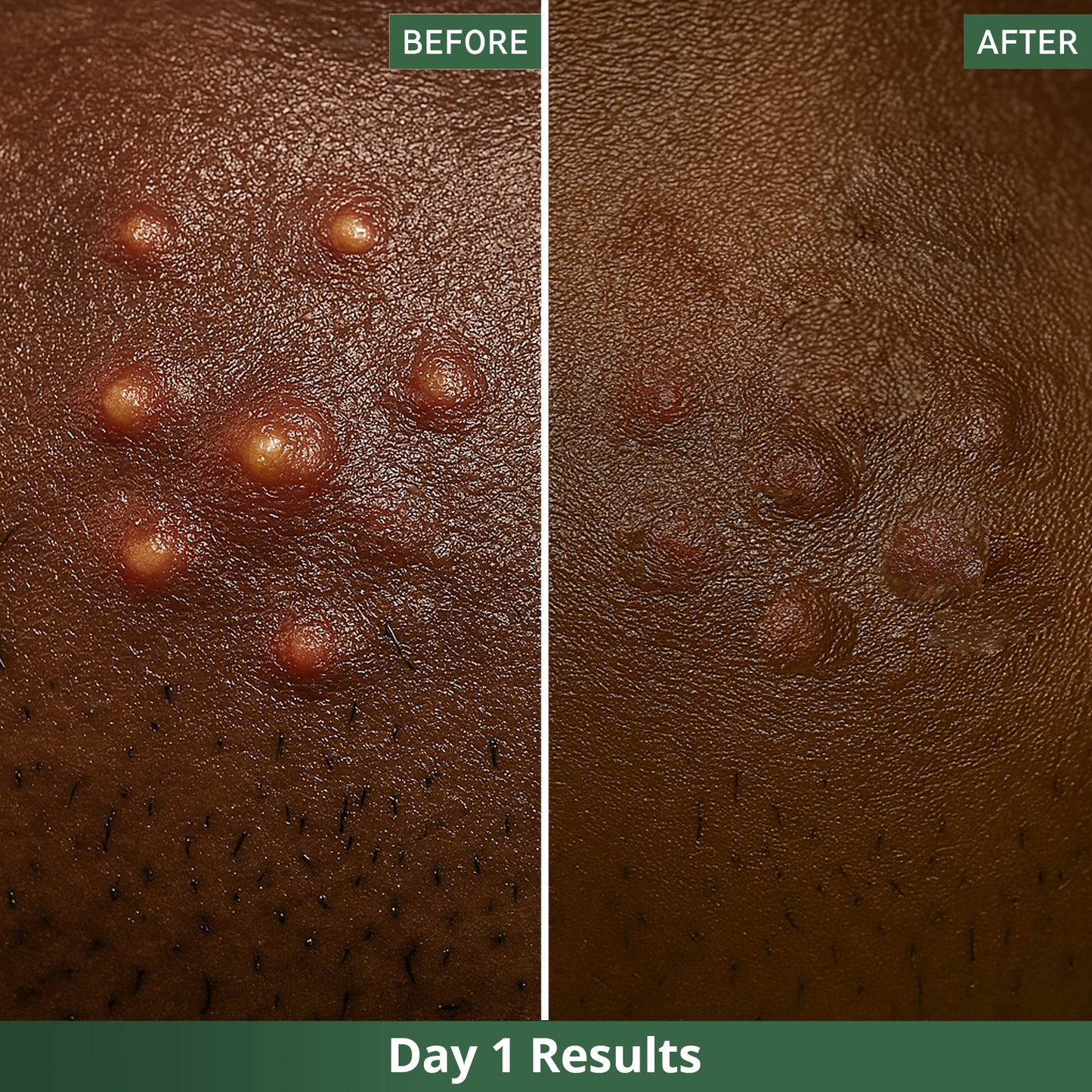 Dots™ Tea Tree Pimple Patches