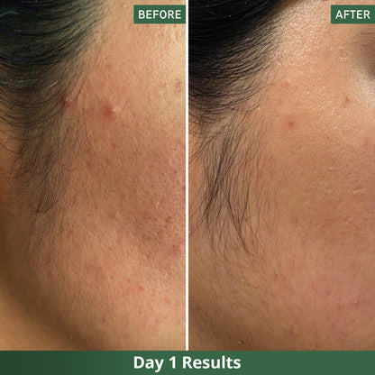 Dots™ Tea Tree Pimple Patches