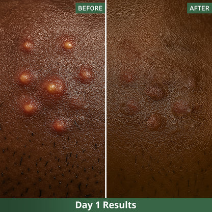 Dots™ Tea Tree Pimple Patches